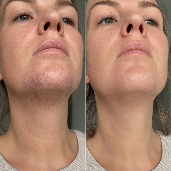 brightskin testimonial lara