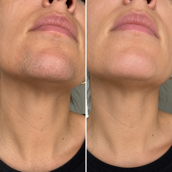 brightskin testimonial sanne
